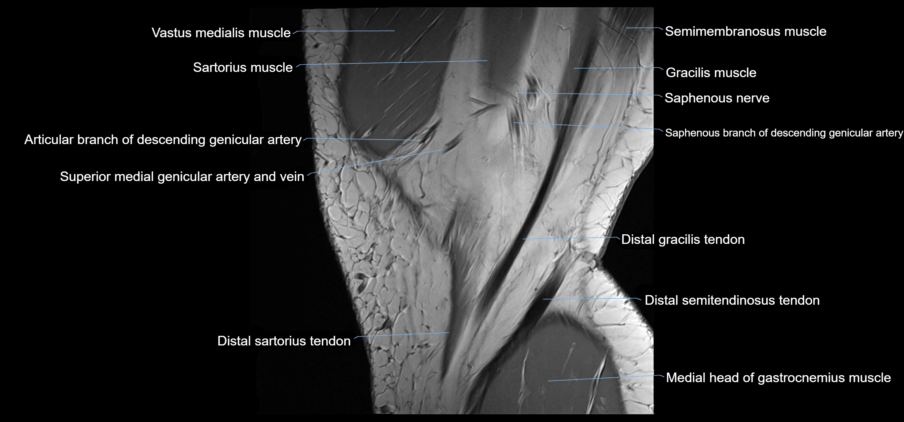 MRI knee sagittal cross sectional anatomy labelled 3T radiology image-00006.webp